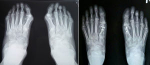 hallux valgus